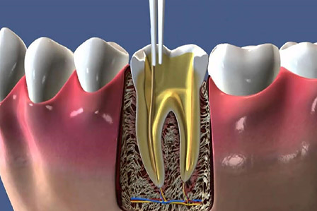 Dentalsancak Endodonti